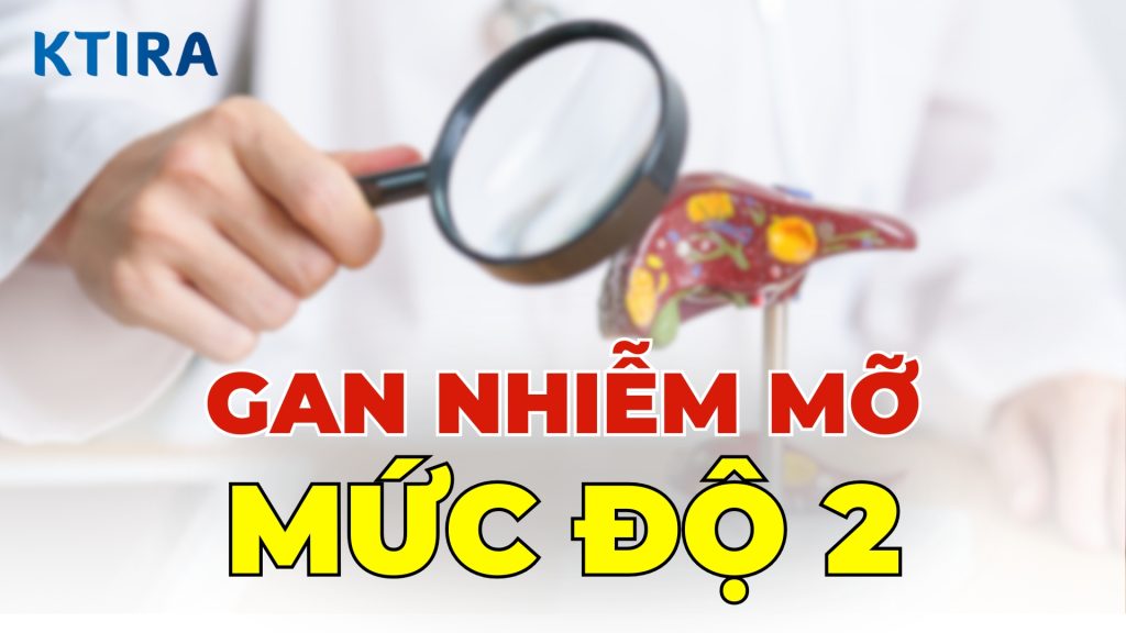 Gan Nhiễm Mỡ Độ 2