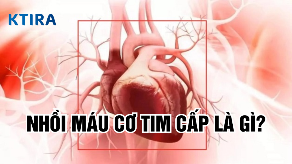 Nhồi máu cơ tim cấp là gì? 5 điều cần biết về nhồi máu cơ tim cấp
