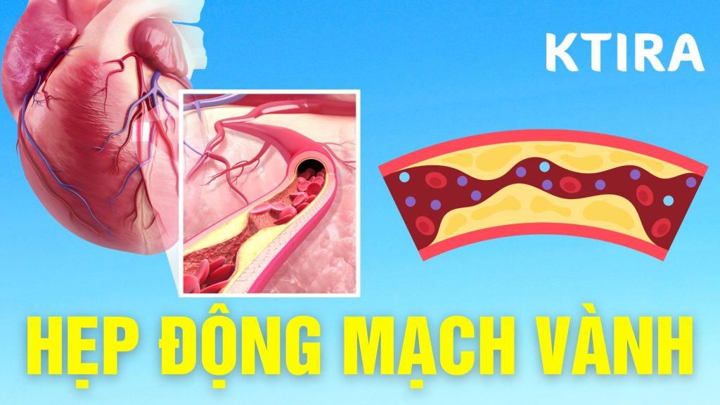 Bệnh hẹp động mạch vành