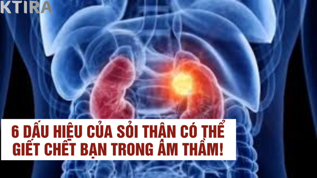 sỏi thận và dấu hiệu mà bạn chưa biết