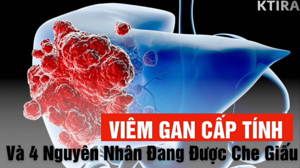 Nguyên Nhân Gây Viêm Gan Cấp Tính