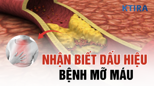 dấu hiệu bệnh mỡ máu Ktira