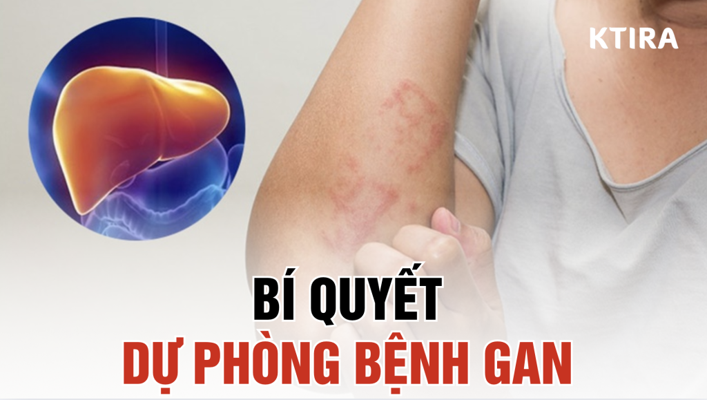 Dự phòng bệnh gan ktira