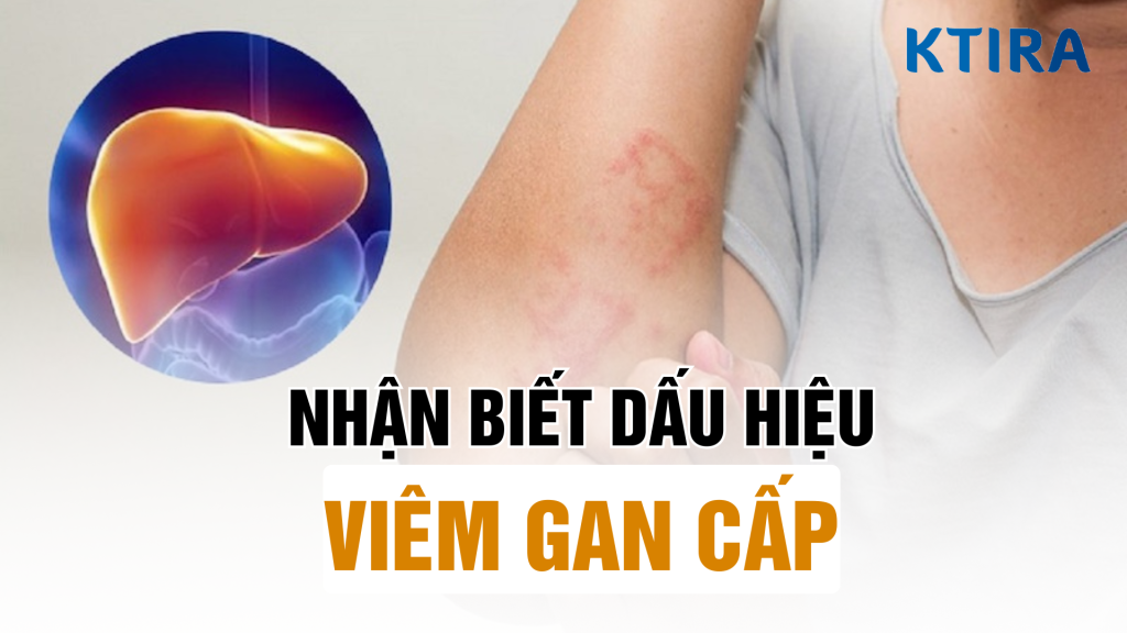 Nhận biết dấu hiệu viêm gan cấp