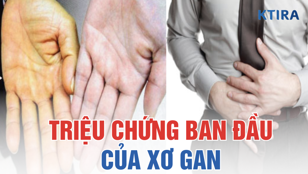 Triệu Chứng Ban Đầu Của Xơ Gan