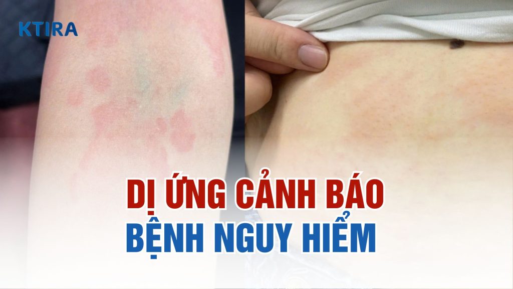 Dị ứng là dấu hiệu cảnh báo 4 bệnh