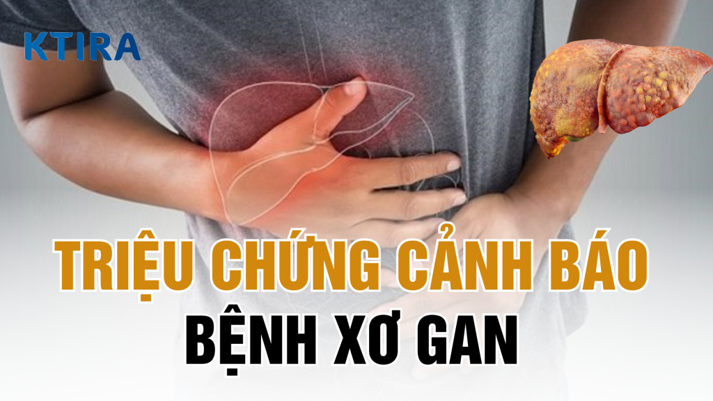 Triệu chứng bệnh xơ gan