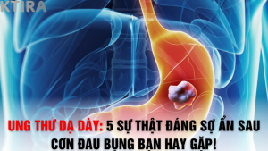 Ung thư dạ dày: 5 Sự thật đáng sợ ẩn sau cơn đau bụng bạn hay gặp!