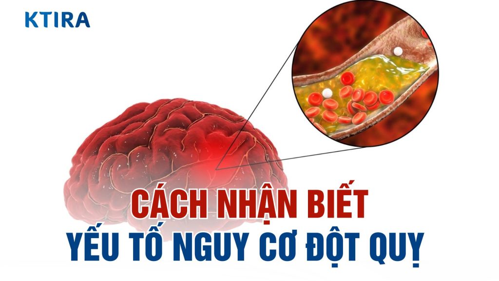 Những yếu tố nguy cơ đột quỵ