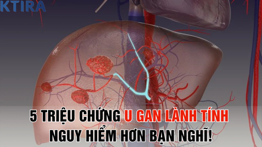 5 Triệu Chứng U Gan Lành Tính Bạn Đang Bỏ Qua Có Thể Nguy Hiểm Hơn Bạn Nghĩ!
