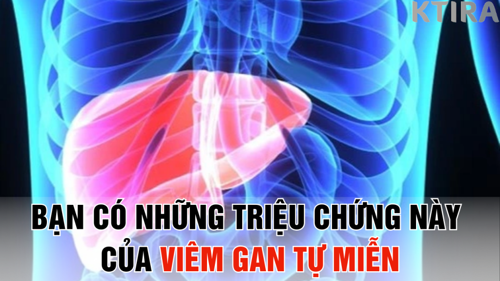 Bạn Có Những Triệu Chứng Này Của Viêm Gan Tự Miễn