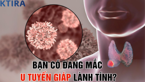 Bạn Có Đang Mắc u tuyến giáp lành tính?