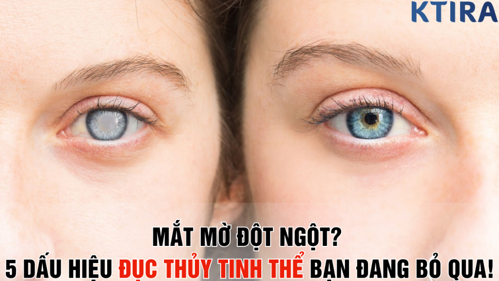 5 Dấu Hiệu Đục Thủy Tinh Thể Bạn Cần Biết