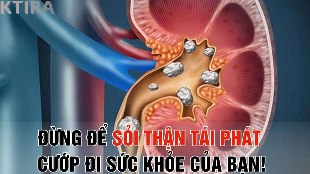 Đừng để sỏi thận tái phát cướp đi sức khỏe của bạn!