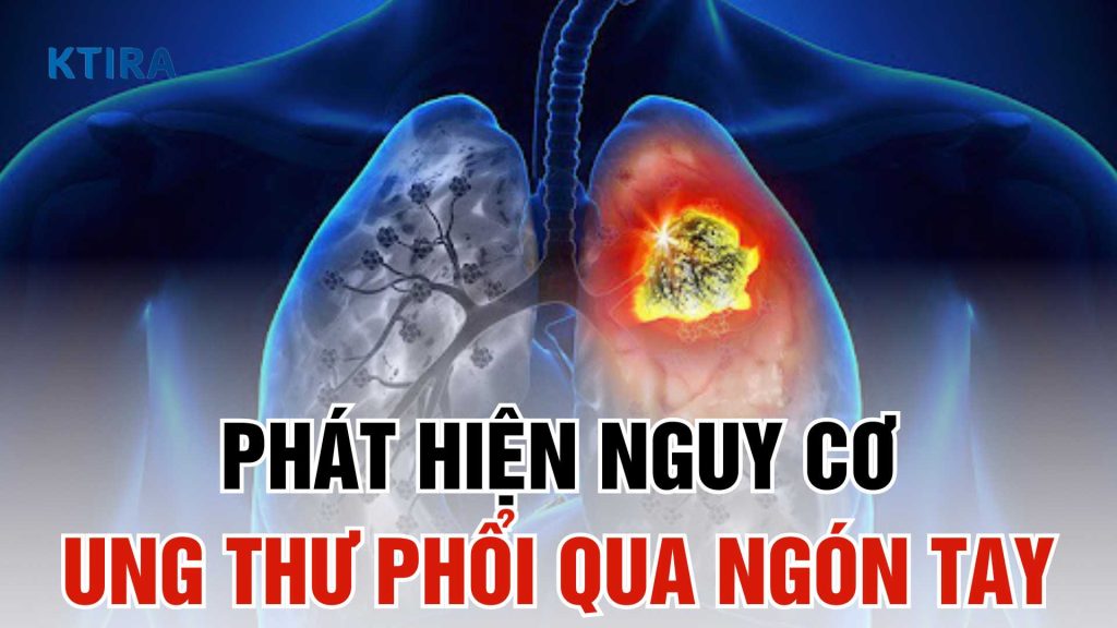 Phát hiện nguy cơ ung thư phổi