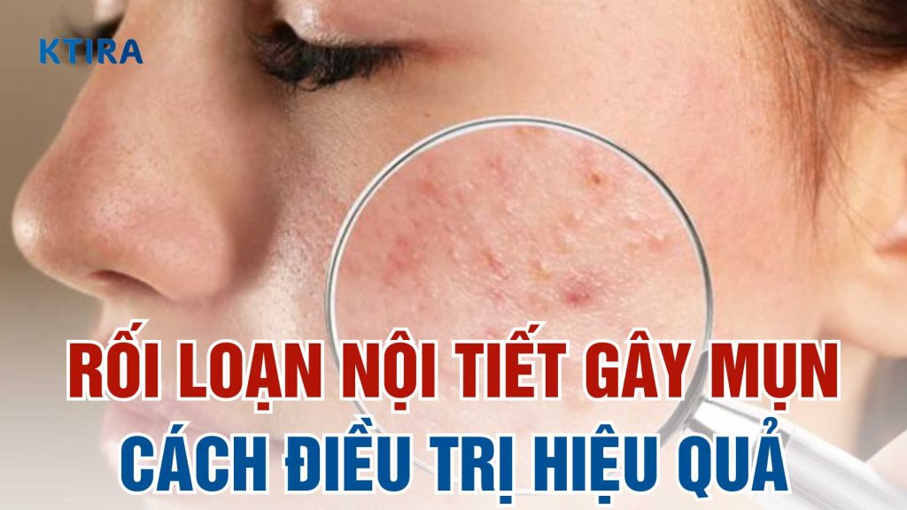 Rối loạn nội tiết gây mụn