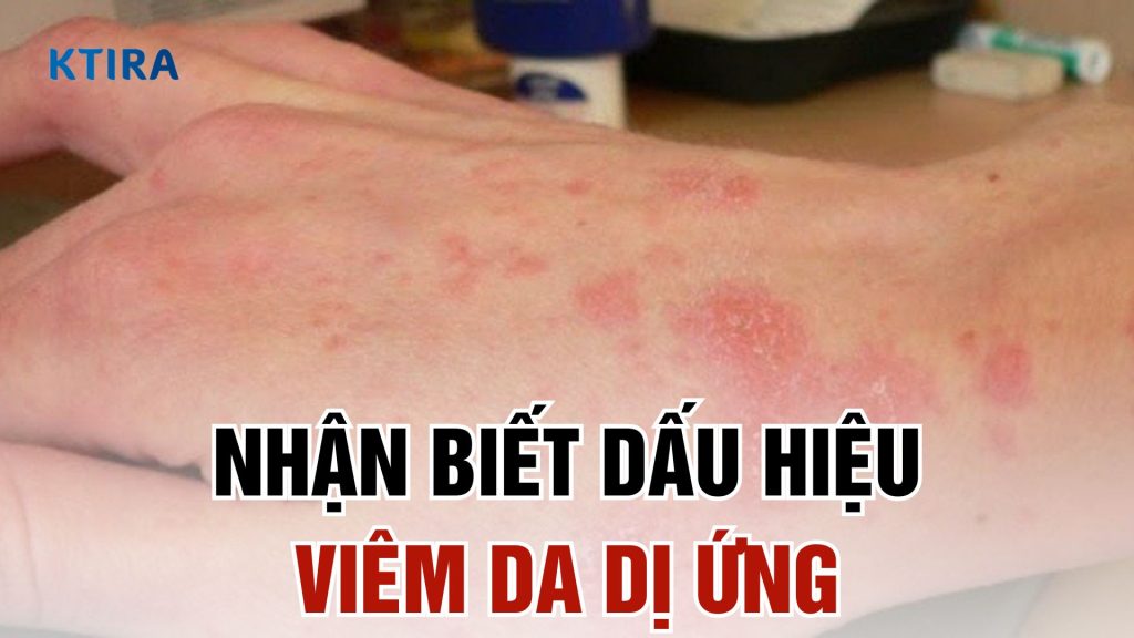Dấu hiệu viêm da dị ứng