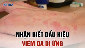Dấu hiệu viêm da dị ứng