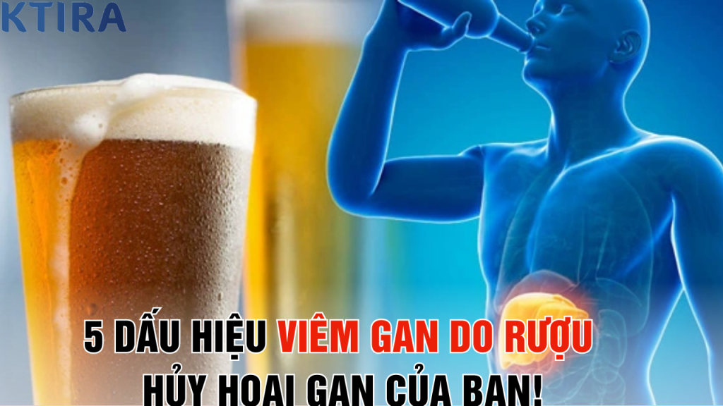 5 Dấu Hiệu Viêm Gan Do Rượu Bạn Đang Bỏ Qua Có Thể Hủy Hoại Gan!