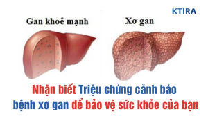 triệu chứng cảnh báo bệnh xơ gan KTIRA