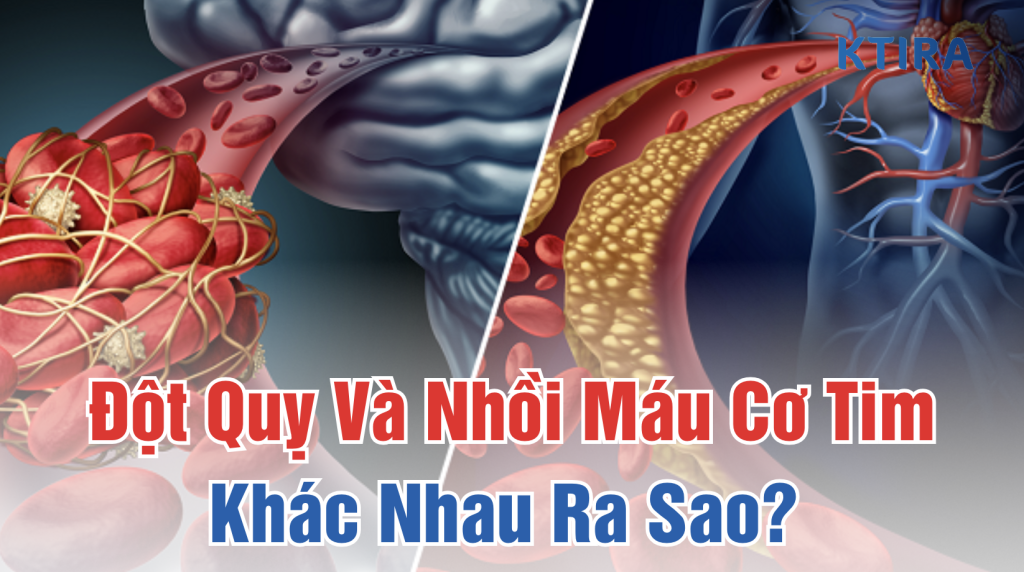 Đột Quỵ Và Nhồi Máu Cơ Tim Khác Nhau Ra Sao KTIRA
