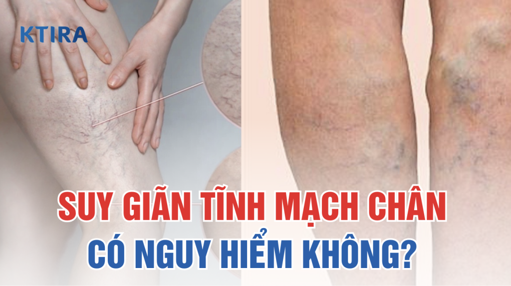 Suy Giãn Tĩnh Mạch Chân Có Nguy Hiểm Không? KTIRA