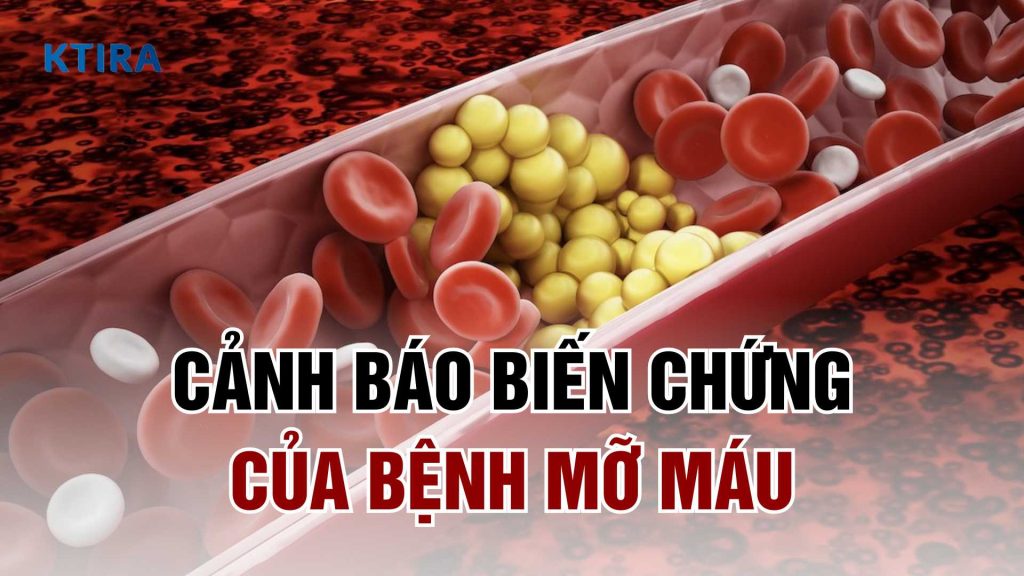 Biến chứng của bệnh mỡ máu