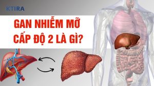Gan nhiễm mỡ cấp độ 2 có nguy hiểm không?