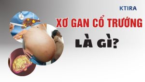 Xơ Gan Cổ Trướng Là Gì?