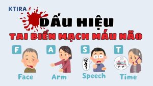 Dấu Hiệu Cảnh Báo Tai Biến Mạch Máu Não
